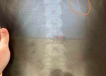 У Дніпрі лікарі допомогли хлопчику, який проковтнув голку |   — новости Днепра