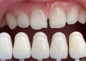 Керамические виниры: для чего они нужны и какой уход им необходим | Одеський Кур’єр